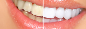 Cosmetic Dentistry teeth whitening Waltham Belmont Newton Watertown MA cosmetic dentistry Cosmetic Dentistry 42