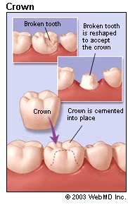 Newton Watertown dentist dental crowns dental crowns Should I consider dental crowns? Newton Watertown dentist dental crown