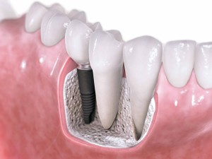 Implant dentistry implant dentistry Should I consider dental implants? Watertown Newton Cambridge dental implants dentist