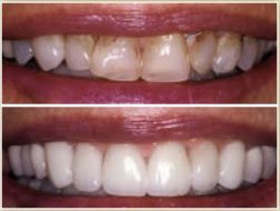 Dental veneers before and after cosmetic dental care Veneers - Improve the Color and Appearance of Your Teeth Cambridge Brighton Cosmetic Dental Care Watertown Newton MA