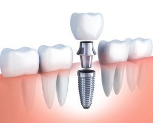 dental implant in Watertown MA dental implant Replace Your Missing Tooth with a Dental Implant p