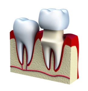 dental crown in Watertown MA dental crown The 3 Best Ways to Maintain Your Dental Crown shutterstock 163167593 1